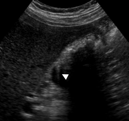 Adenomyomatosis in a 39-year-old woman.  US  shows mural thickening with calcifications with the characteristic 'comet-tail' reverberation artifact (arrow)  due to small cholesterol crystals within Rokitansky-Aschoff sinuses.